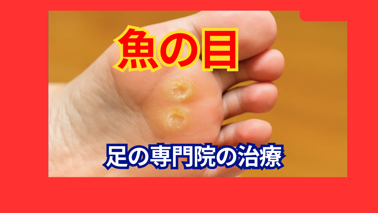 川崎市多摩区で魚の目でお困りの方へ 画像
