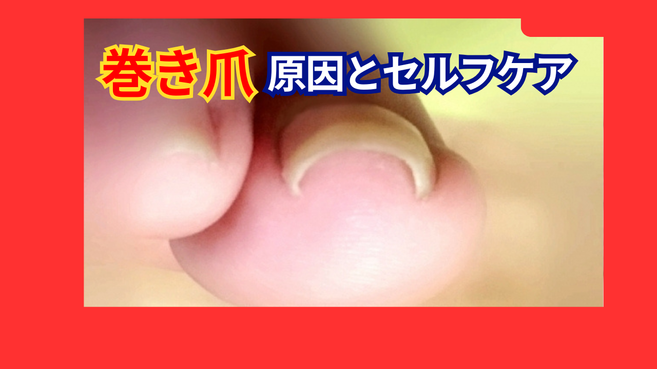 川崎市多摩区で巻き爪でお悩みの方へ 画像